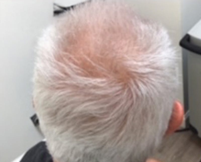 Injections for Hair Loss (PRFM) Before & After Gallery - Patient 301484 - Image 1