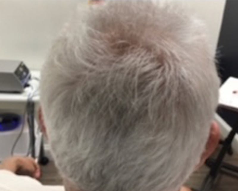 Injections for Hair Loss (PRFM) Before & After Gallery - Patient 301484 - Image 2