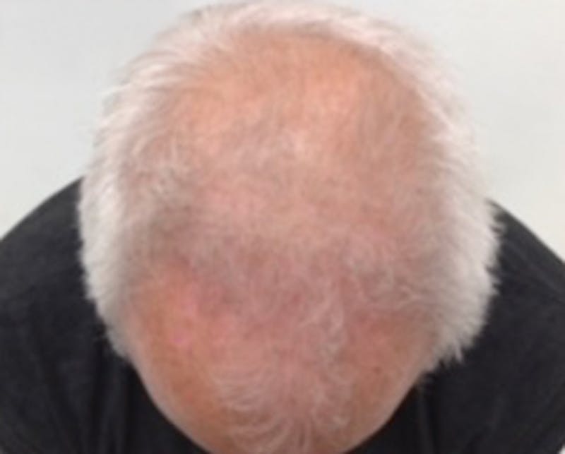 Injections for Hair Loss (PRFM) Before & After Gallery - Patient 359087 - Image 1