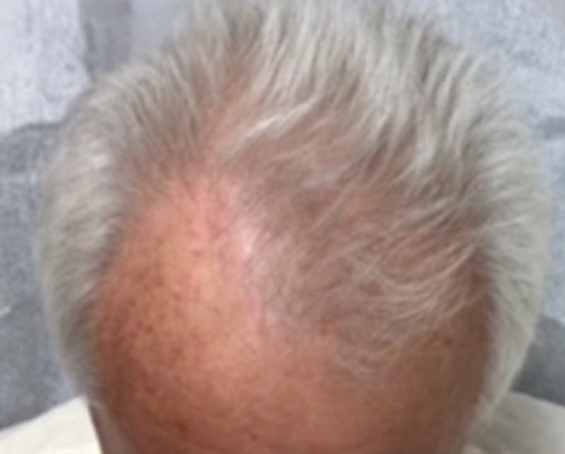Injections for Hair Loss (PRFM) Before & After Gallery - Patient 359087 - Image 2