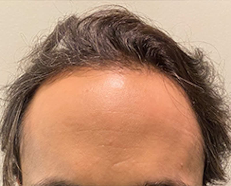 Injections for Hair Loss (PRFM) Before & After Gallery - Patient 466440 - Image 1