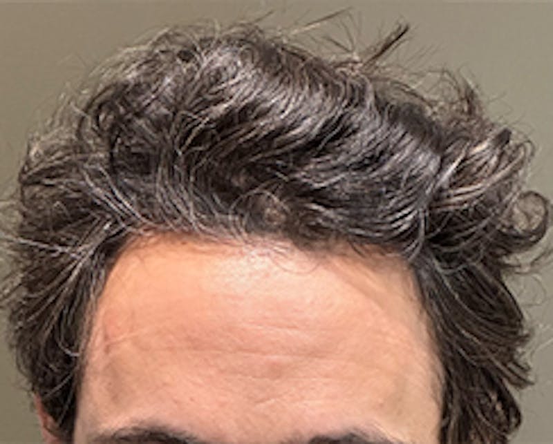 Injections for Hair Loss (PRFM) Before & After Gallery - Patient 466440 - Image 2