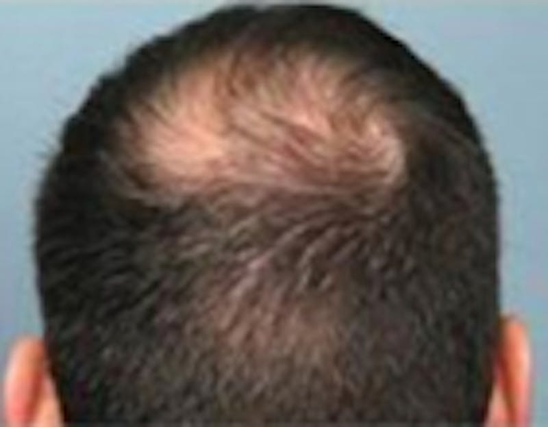 Red Light (LED) Therapy Before & After Gallery - Patient 775099 - Image 1