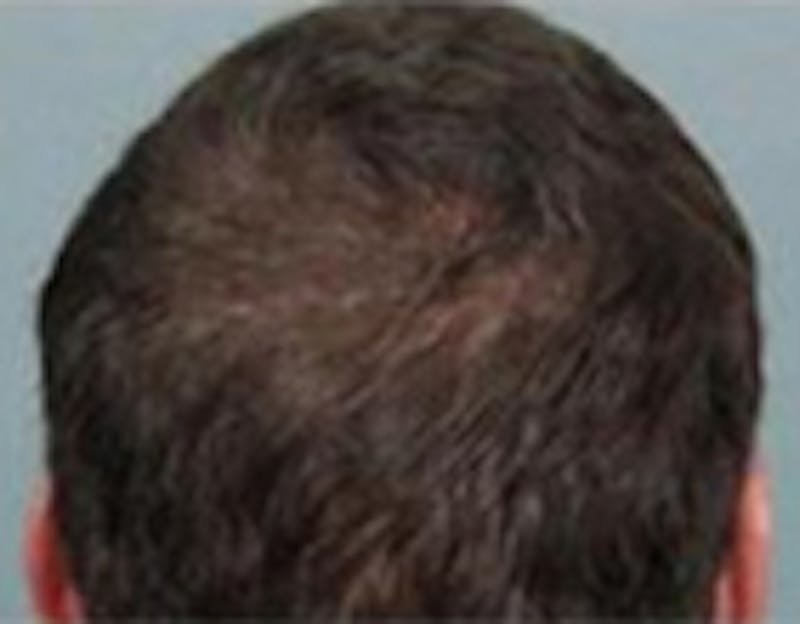 Red Light (LED) Therapy Before & After Gallery - Patient 775099 - Image 2