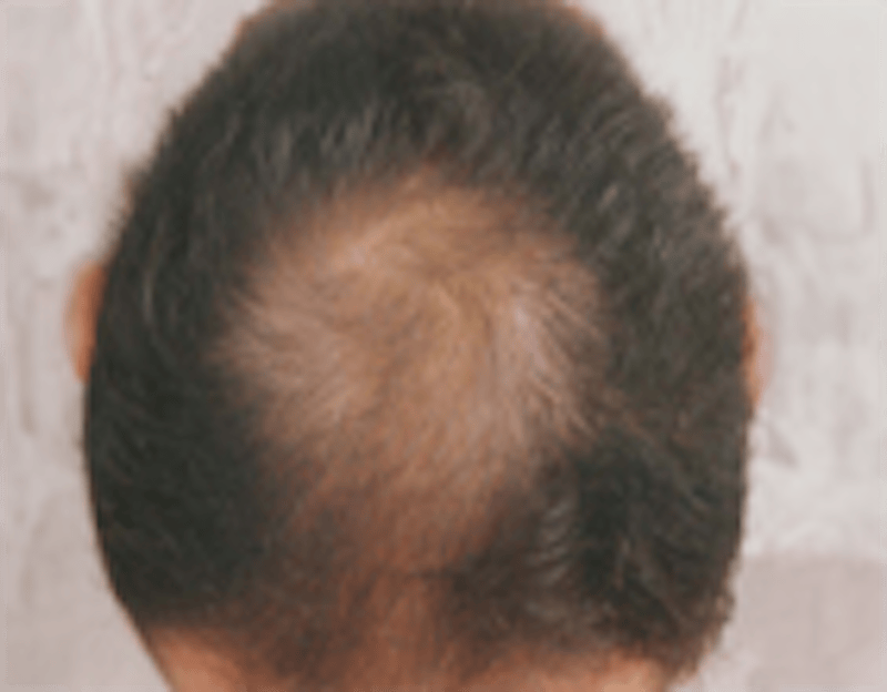 Red Light (LED) Therapy Before & After Gallery - Patient 398062 - Image 1