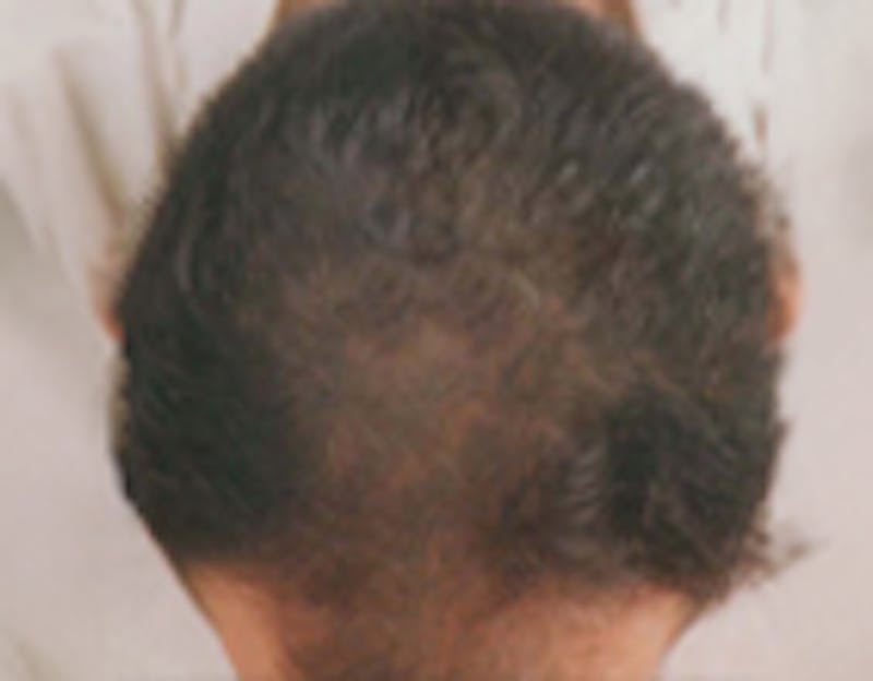 Red Light (LED) Therapy Before & After Gallery - Patient 398062 - Image 2
