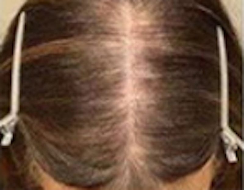 Red Light (LED) Therapy Before & After Gallery - Patient 366230 - Image 1