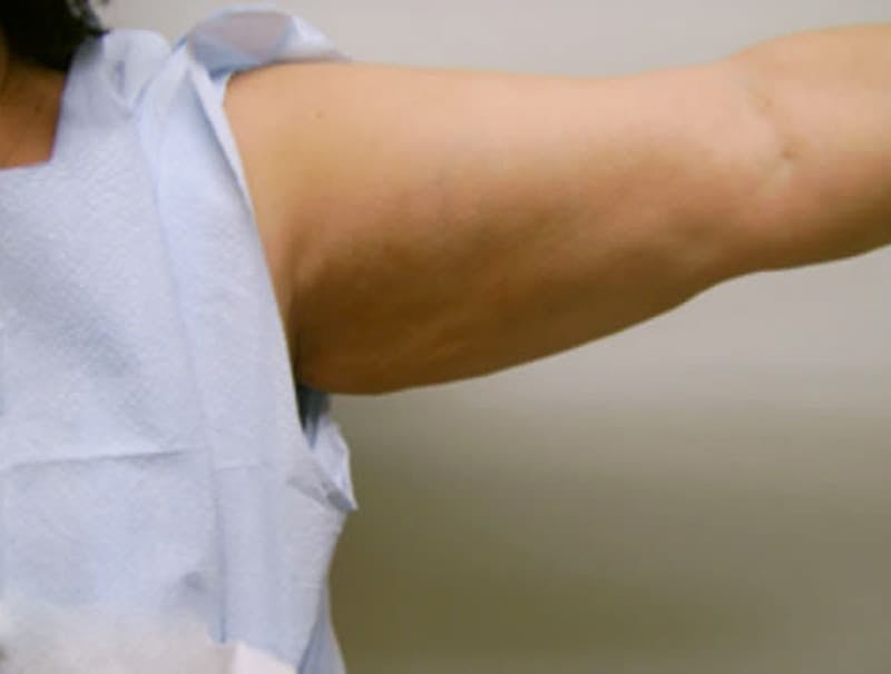 Smartlipo Before & After Gallery - Patient 421165 - Image 2
