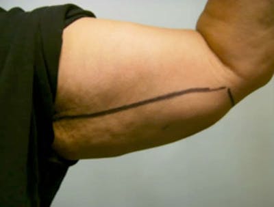 Smartlipo Before & After Gallery - Patient 421165 - Image 1