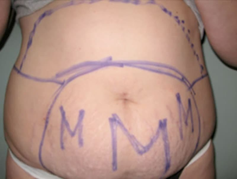 Smartlipo Before & After Gallery - Patient 312172 - Image 1