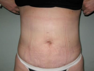 Smartlipo Before & After Gallery - Patient 312172 - Image 2