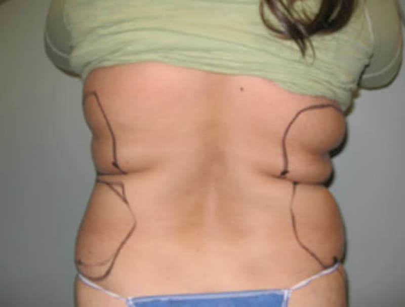 Smartlipo Before & After Gallery - Patient 134931 - Image 1