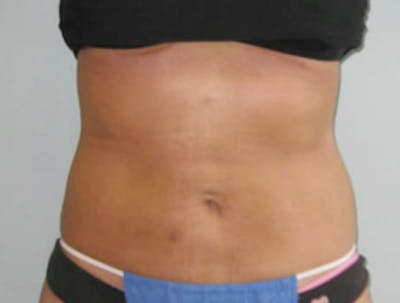 Smartlipo Before & After Gallery - Patient 362426 - Image 2