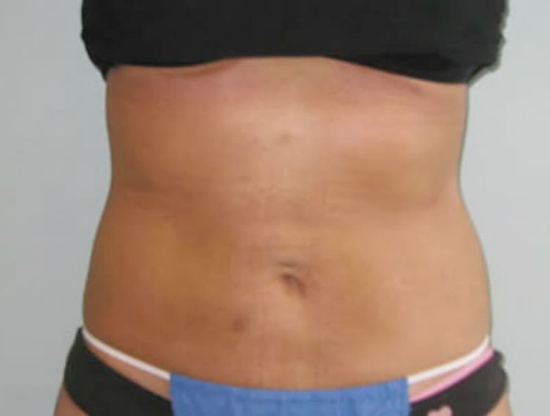 Smartlipo Before & After Gallery - Patient 362426 - Image 2