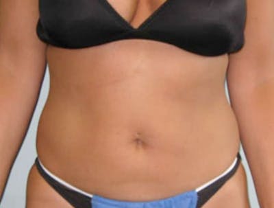 Smartlipo Before & After Gallery - Patient 362426 - Image 1