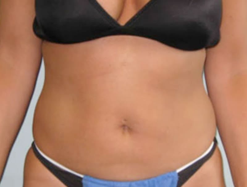 Smartlipo Before & After Gallery - Patient 362426 - Image 1
