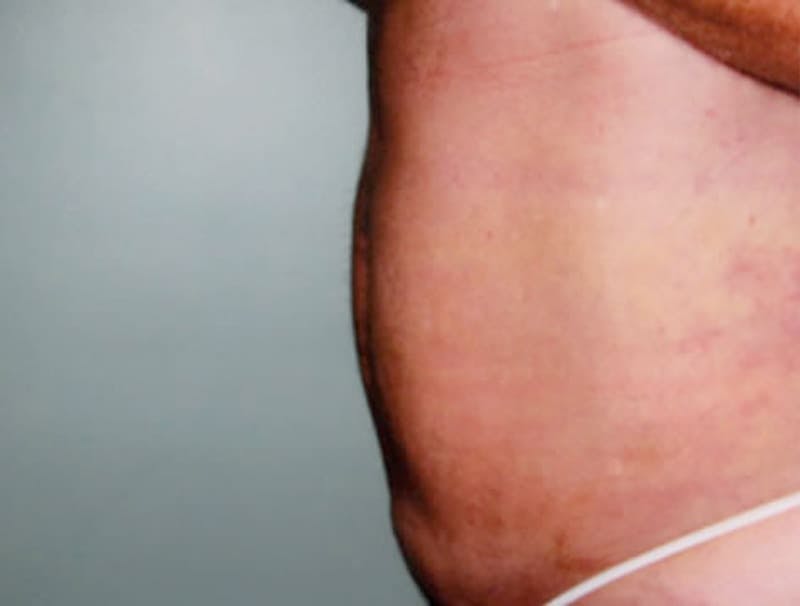 Smartlipo Before & After Gallery - Patient 287707 - Image 2