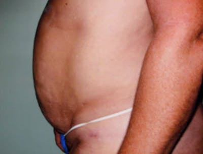 Smartlipo Before & After Gallery - Patient 287707 - Image 1