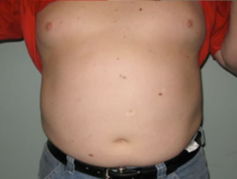 Smartlipo Before & After Gallery - Patient 655281 - Image 2