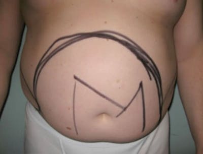 Smartlipo Before & After Gallery - Patient 655281 - Image 1
