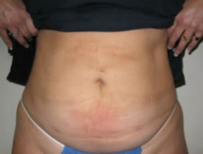 Smartlipo Before & After Gallery - Patient 775058 - Image 2