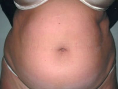 Smartlipo Before & After Gallery - Patient 775058 - Image 1