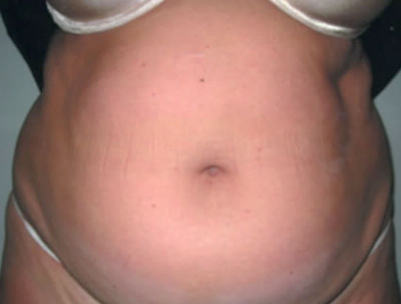 Smartlipo Before & After Gallery - Patient 775058 - Image 1