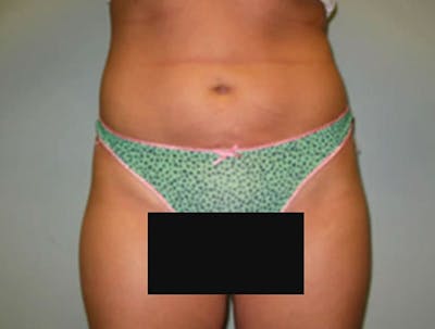 Smartlipo Before & After Gallery - Patient 181009 - Image 2