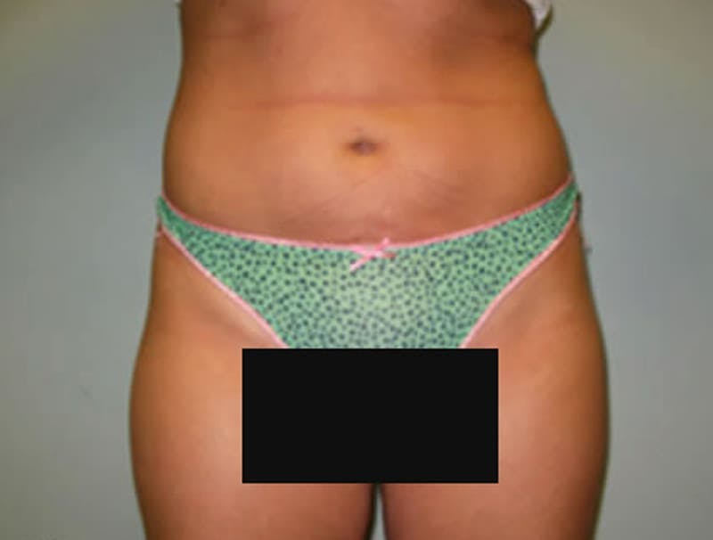 Smartlipo Before & After Gallery - Patient 181009 - Image 2