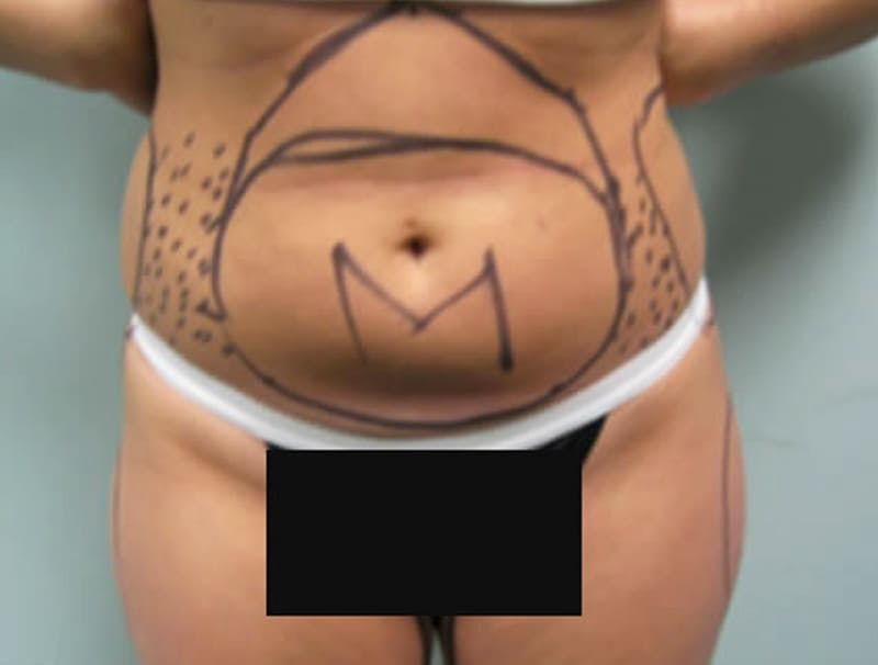 Smartlipo Before & After Gallery - Patient 181009 - Image 1