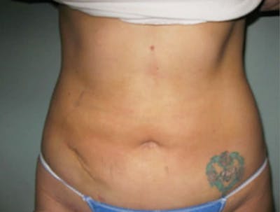 Smartlipo Before & After Gallery - Patient 224717 - Image 2