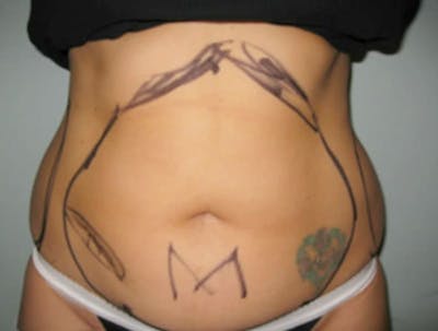 Smartlipo Before & After Gallery - Patient 224717 - Image 1