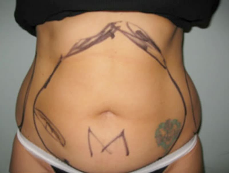 Smartlipo Before & After Gallery - Patient 224717 - Image 1