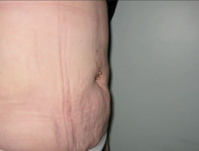 Smartlipo Before & After Gallery - Patient 296646 - Image 2