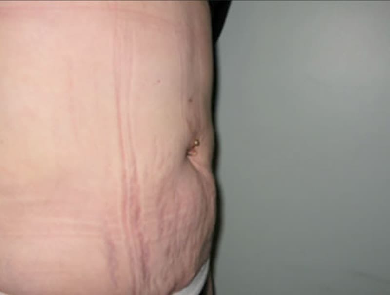 Smartlipo Before & After Gallery - Patient 296646 - Image 2