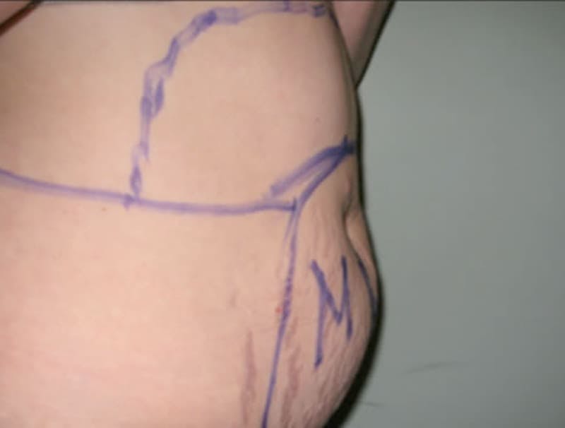 Smartlipo Before & After Gallery - Patient 296646 - Image 1