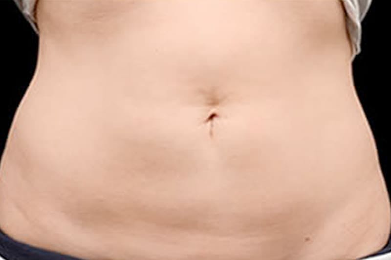 Coolsculpting Body Fat Reduction Before & After Gallery - Patient 100269 - Image 2