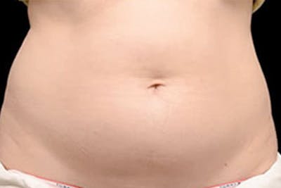 Coolsculpting Body Fat Reduction Before & After Gallery - Patient 100269 - Image 1