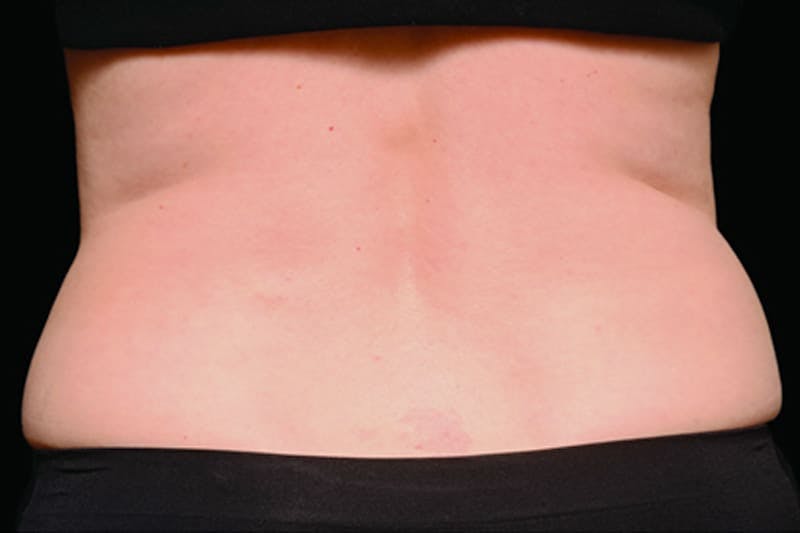 Coolsculpting Body Fat Reduction Before & After Gallery - Patient 175736 - Image 2