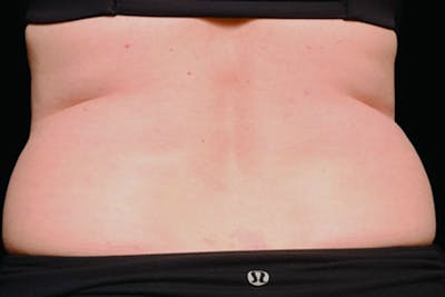 Coolsculpting Body Fat Reduction Before & After Gallery - Patient 175736 - Image 1