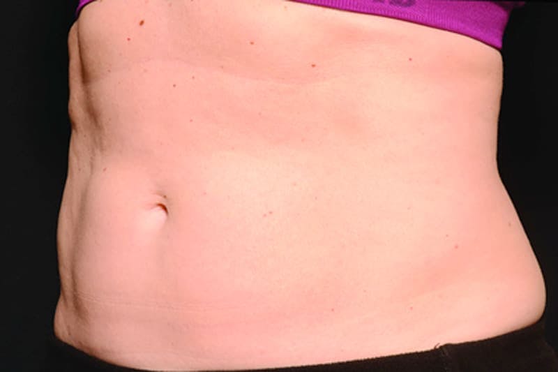 Coolsculpting Body Fat Reduction Before & After Gallery - Patient 308254 - Image 2