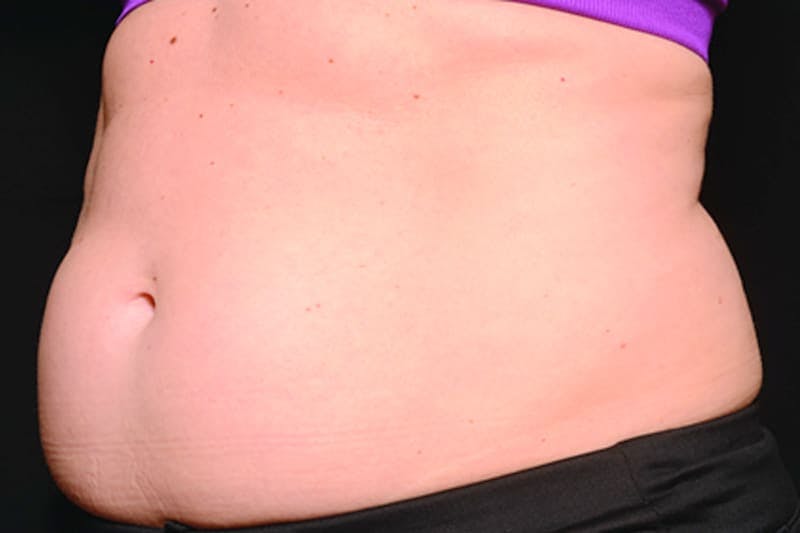 Coolsculpting Body Fat Reduction Before & After Gallery - Patient 308254 - Image 1