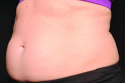 Coolsculpting Body Fat Reduction Before & After Gallery - Patient 308254 - Image 1