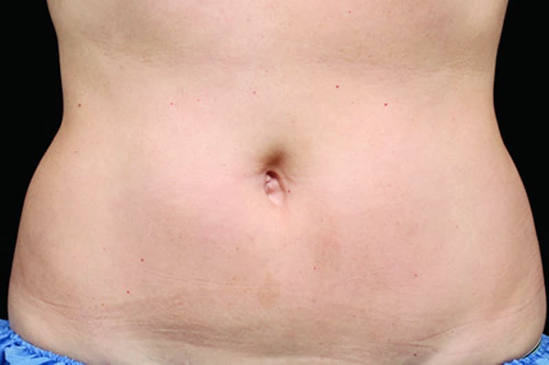 Coolsculpting Body Fat Reduction Before & After Gallery - Patient 303044 - Image 2