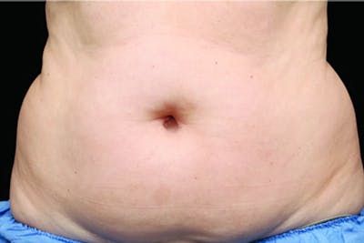 Coolsculpting Body Fat Reduction Before & After Gallery - Patient 303044 - Image 1