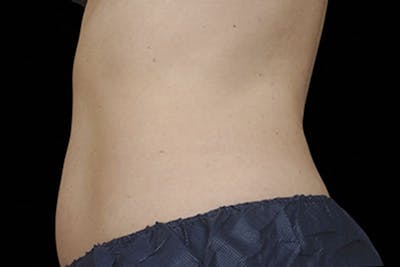 Coolsculpting Body Fat Reduction Before & After Gallery - Patient 366590 - Image 2