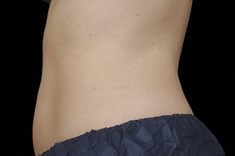 Coolsculpting Body Fat Reduction Before & After Gallery - Patient 366590 - Image 2
