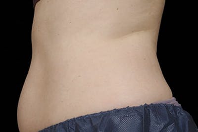 Coolsculpting Body Fat Reduction Before & After Gallery - Patient 366590 - Image 1