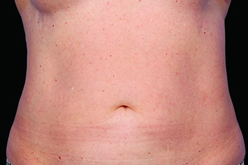 Coolsculpting Body Fat Reduction Before & After Gallery - Patient 214288 - Image 2