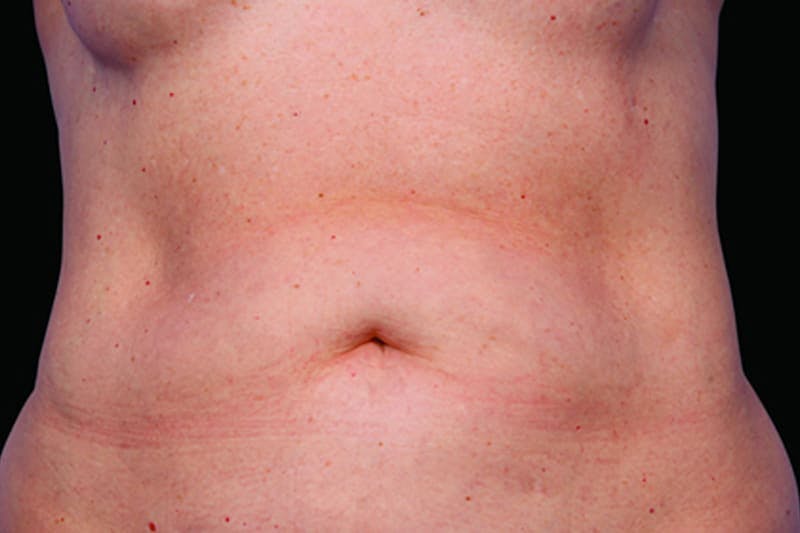 Coolsculpting Body Fat Reduction Before & After Gallery - Patient 214288 - Image 1